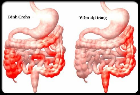 Bệnh Crohn nguyên nhân, phương pháp điều trị