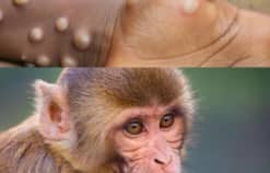 Bệnh đậu mùa khỉ: các giai đoạn tiến triển, triệu chứng, biến chứng nguy hiểm