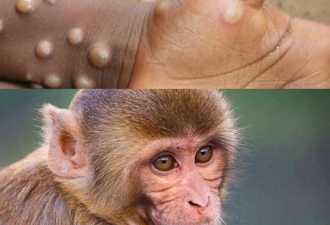 Bệnh đậu mùa khỉ các giai đoạn tiến triển, triệu chứng, biến chứng nguy hiểm