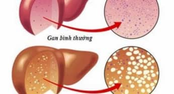 Bệnh gan nhiễm mỡ không do rượu và do rượu: Điều trị, phòng ngừa cách nào