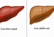 Bệnh gan nhiễm mỡ: phân biệt các loại gan nhiễm mỡ NAFLD, NAFL, NASH