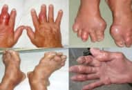 Bệnh Gout (Gút) là gì