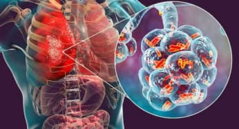 Nhiễm trùng Legionella gây Bệnh Legionnaires