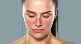 Lupus ban đỏ những biến chứng nguy hiểm