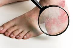 Bệnh nấm da chân rất dễ lây, lan ra các bộ phận khác