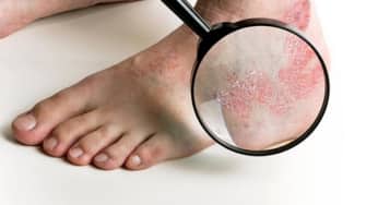 Bệnh nấm da chân rất dễ lây, lan ra các bộ phận khác