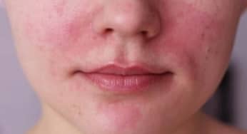Bệnh Rosacea gây tình trạng ửng đỏ của da: nguyên nhân, chẩn đoán, điều trị