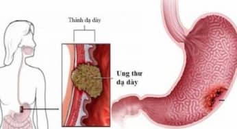 Bệnh ung thư dạ dày ngày một gia tăng
