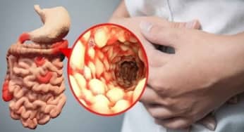Bệnh viêm ruột: nguyên nhân, biến chứng, chẩn đoán và điều trị