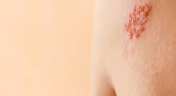 Bệnh Zona: biến chứng, nguyên nhân, triệu chứng, điều trị