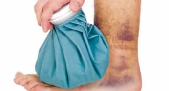 Bong gân dấu hiệu phát hiện, xử trí điều trị