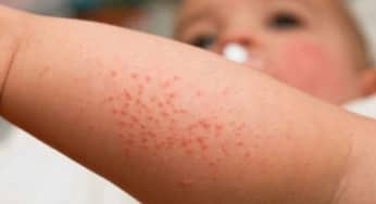 Các dạng bệnh rôm sảy phổ biến, cách phòng ngừa, điều trị tại nhà