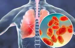 Các loại áp xe phổi: nguyên nhân, triệu chứng, các giai đoạn của áp xe phổi