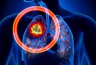 Các loại bệnh ung thư phổi
