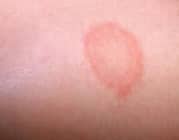 Cách nhận biết bệnh hắc lào, phương pháp phòng ngừa