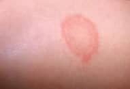 Cách nhận biết bệnh hắc lào, phương pháp phòng ngừa