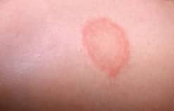 Cách nhận biết bệnh hắc lào, phương pháp phòng ngừa