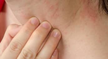 Cách phân biệt mẩn ngứa do gan và mẩn ngứa thông thường