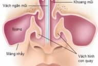 Chẩn đoán, xử trí chấn thương tai mũi họng