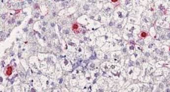 Virus mới gây bệnh viêm gan ở người vừa được phát hiện tại Pháp