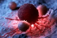 Công nghệ cấy ghép có thể loại bỏ ung thư trong 2 tháng