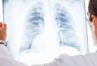 COVID-19 gây tổn thương phổi như thế nào? có phục hồi được phổi không?