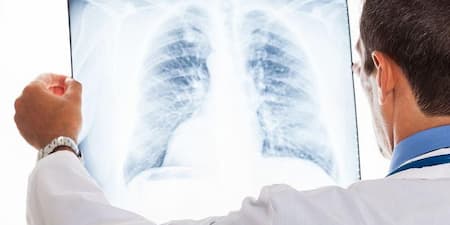 COVID-19 gây tổn thương phổi như thế nào? có phục hồi được phổi không