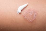 Đặc tính của bệnh hắc lào, giải pháp