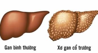 Đánh giá, điều trị cổ trướng ở bệnh nhân xơ gan