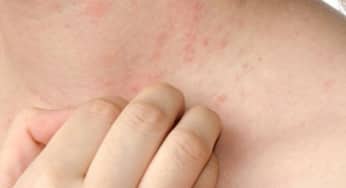 Dị ứng thuốc: sốc phản vệ nguyên nhân, triệu chứng, cách phòng ngừa