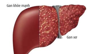 Điều trị dự phòng nhiễm trùng cổ trướng