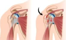 Điều trị rách gân cơ chóp xoay vai, những khuyến cáo