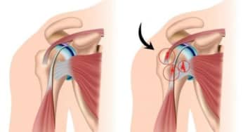 Điều trị rách gân cơ chóp xoay vai, những khuyến cáo