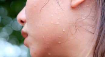 Dấu hiệu của bệnh khi đổ mồ hôi nhiều