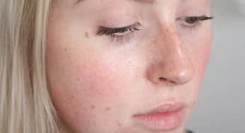Đốm đỏ trên mặt đề phòng bệnh gan nhiễm mỡ
