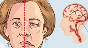 Đột quỵ, tai biến mạch não: dấu hiệu, xử trí cấp cứu, phòng ngừa