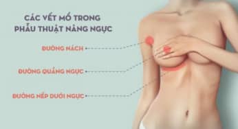 Nâng ngực nên chọn đường mổ nào?
