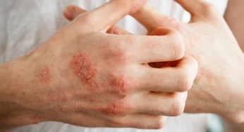 Gặp vấn đề về tiêu hóa khi mắc bệnh vẩy nến