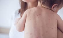 Giai đoạn trẻ mắc bệnh sởi cha mẹ cần cẩn trọng tránh biến chứng