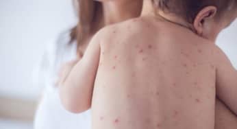 Giai đoạn trẻ mắc bệnh sởi cha mẹ cần cẩn trọng tránh biến chứng