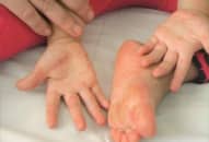 <strong>Giải pháp ngăn ngừa bệnh tay chân miệng lây lan trong cộng đồng</strong>