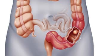 Hiểu biết đầy đủ về bệnh túi thừa