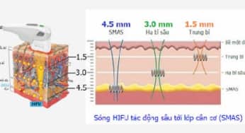 Hifu++ có gì khác biệt so với các phương pháp hifu đơn trị liệu khác