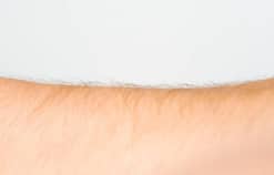 Hội chứng người sói căn bệnh da liễu hiếm gặp