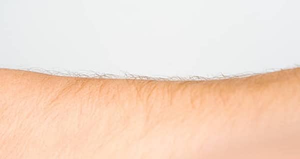 Hội chứng người sói căn bệnh da liễu hiếm gặp