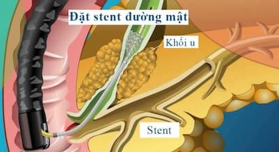 Hướng dẫn đặt dẫn lưu đường mật, đặt stent đường mật