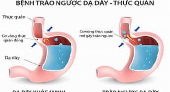 Hướng dẫn điều trị bệnh trào ngược dạ dày thực quản