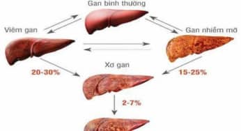 Hướng dẫn điều trị xơ gan, xét nghiệm