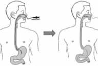 Hướng dẫn nội soi thực quản – dạ dày – tá tràng qua đường mũi
