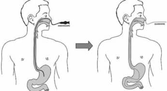 Hướng dẫn nội soi thực quản – dạ dày – tá tràng qua đường mũi